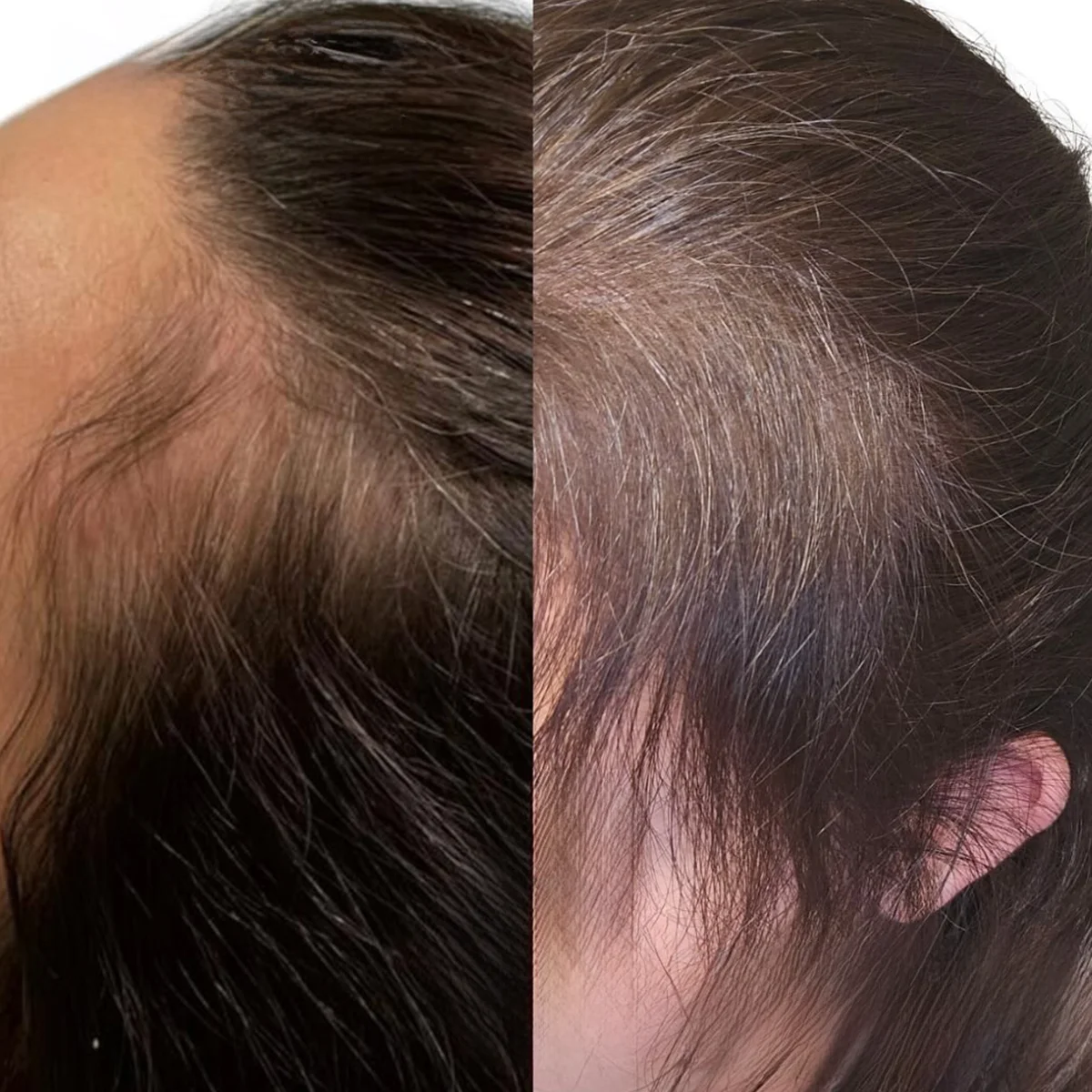 PRP hair restoration before and after